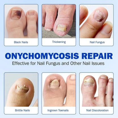 Fungal Nail Treatment Patches – Fast-Acting Antifungal Repair for Healthy Nails